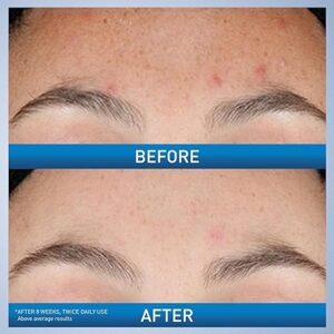CeraVe Resurfacing Retinol Serum For Post Acne Marks, Formulated With Licorice Root Extract & Niacinamide, Brightening Serum & Pore Minimizer For Face, Post Acne Skin Barrier Repair, Non-Comedogenic - Image 4